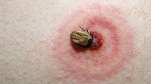 Tick